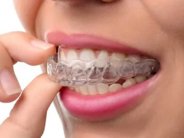 The 3 Things To Expect When You Get Invisalign Braces