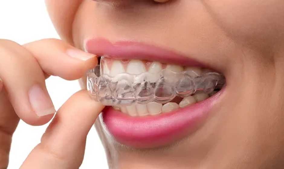 The 3 Things To Expect When You Get Invisalign Braces