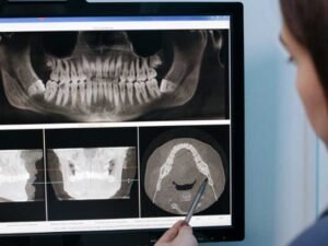 Simplifying Complex Cases with Internal Hex Implant Systems