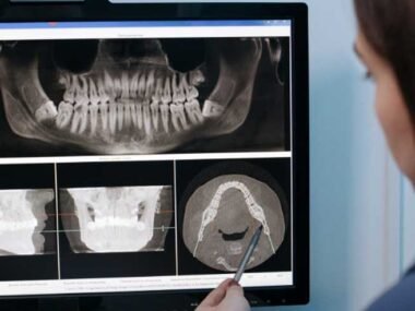 Simplifying Complex Cases with Internal Hex Implant Systems