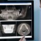 Simplifying Complex Cases with Internal Hex Implant Systems