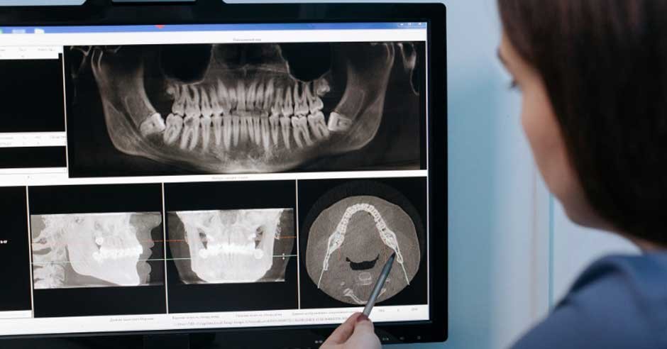 Simplifying Complex Cases with Internal Hex Implant Systems